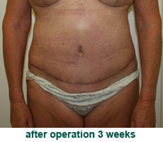 plastic-surgery-tummy-tuck